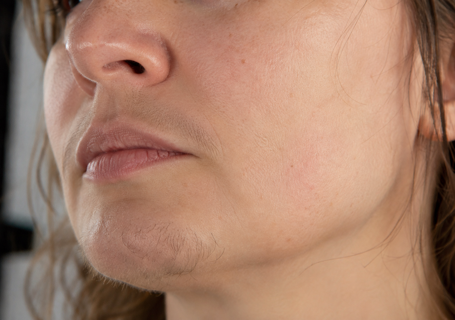 Poils du menton et de la lèvre supérieure, pilosité du visage à influence hormonale